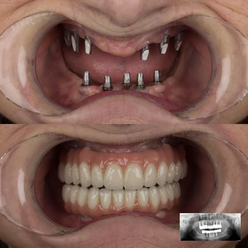 Before and after dental implant case at DENTAGLOBAL