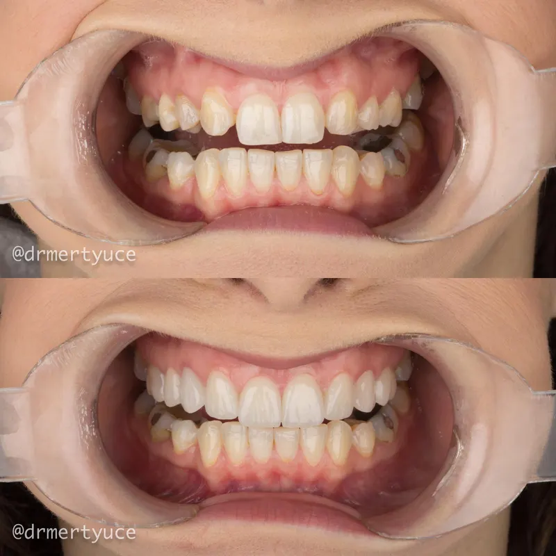 Before and after dental implant case at DENTAGLOBAL