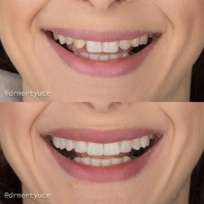 Before and after dental implant case at DENTAGLOBAL