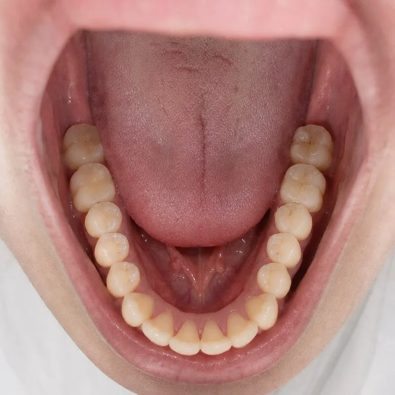 Example lower jaw dental photo
