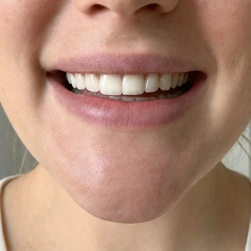 Example natural smile photo