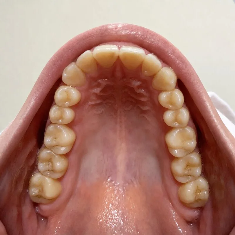 Example upper jaw dental photo